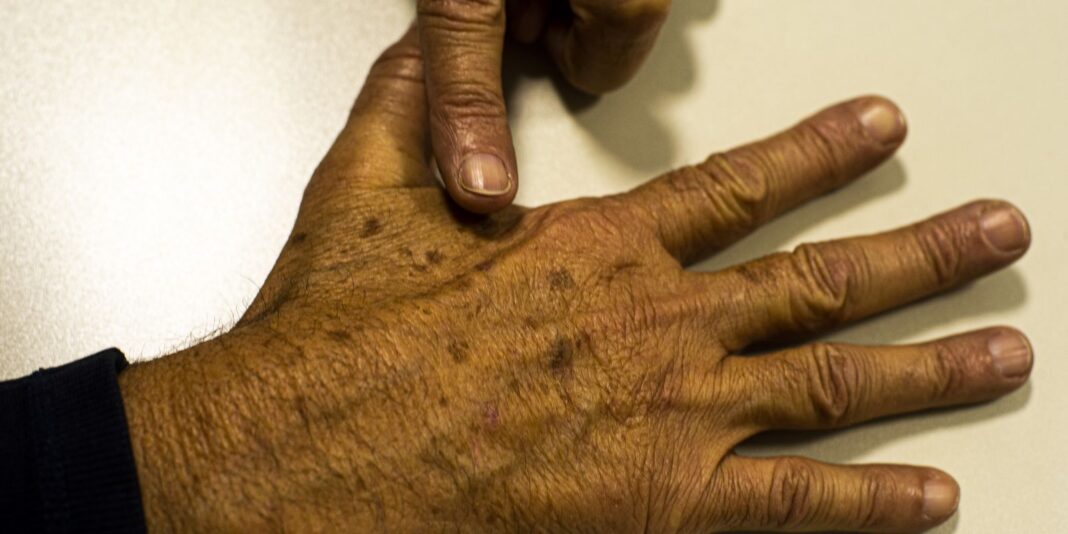 Desinformação sobre câncer de pele prejudica diagnóstico, afirma instituição