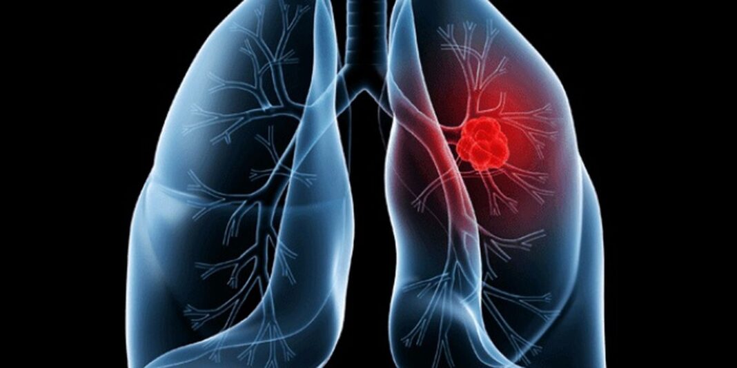 Saiba o que é adenocarcinoma pulmonar, câncer que atinge o papa